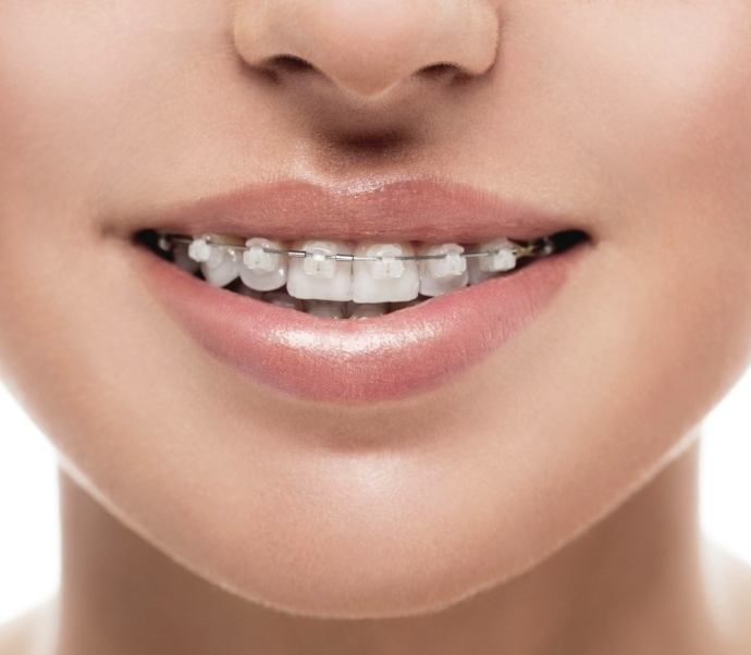 Close up of smile with braces with transparent brackets