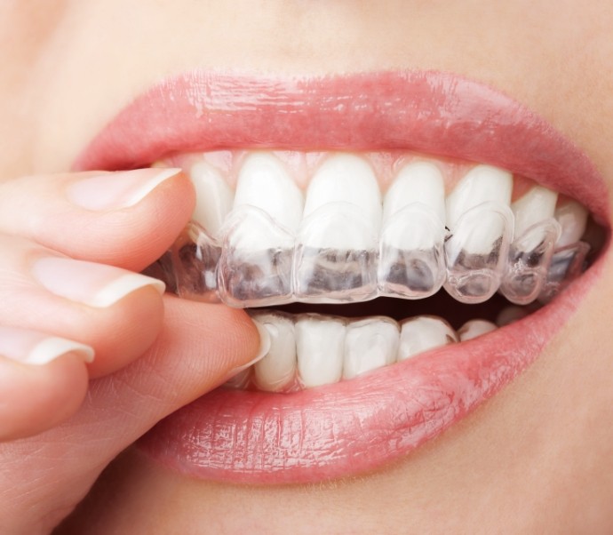 Person placing an Invisalign clear aligner over their teeth