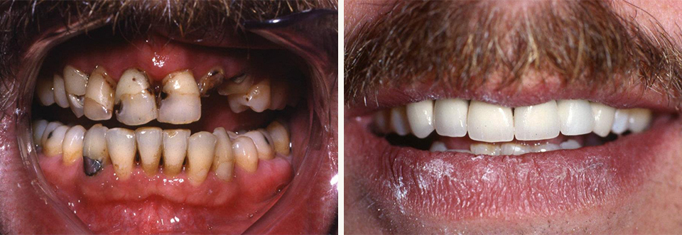 CLose up of man smiling before and after restoring damaged teeth