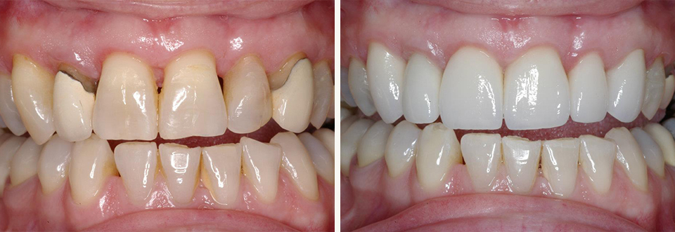 Close up of mouth before and after treating discolored and damaged teeth