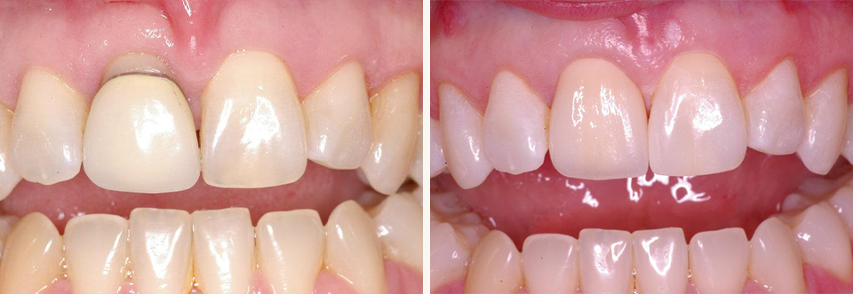 Close up of stained and discolored teeth before and after dental treatment