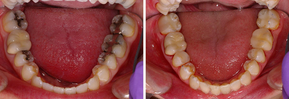 Close up of lower row of teeth before and after replacing old metal restorations