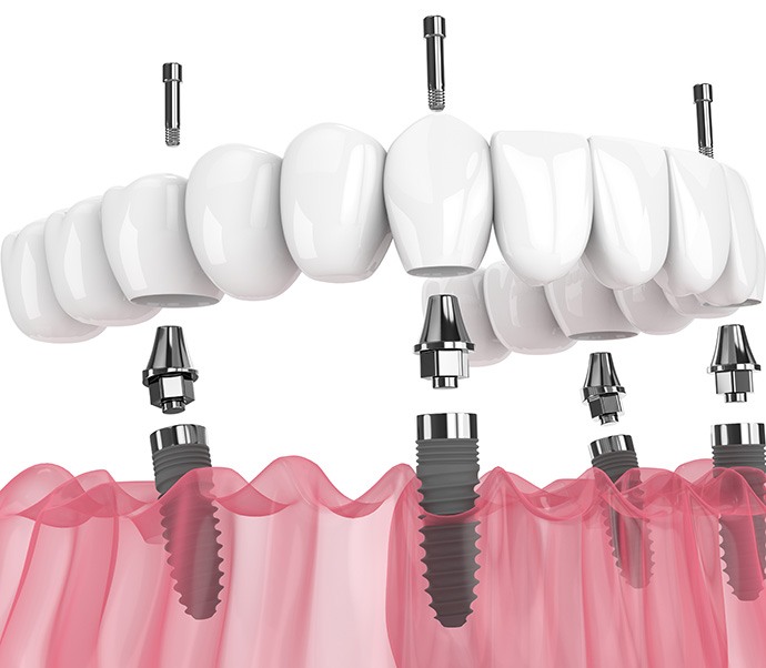 Illustration showing All-on-4 implants for lower arch