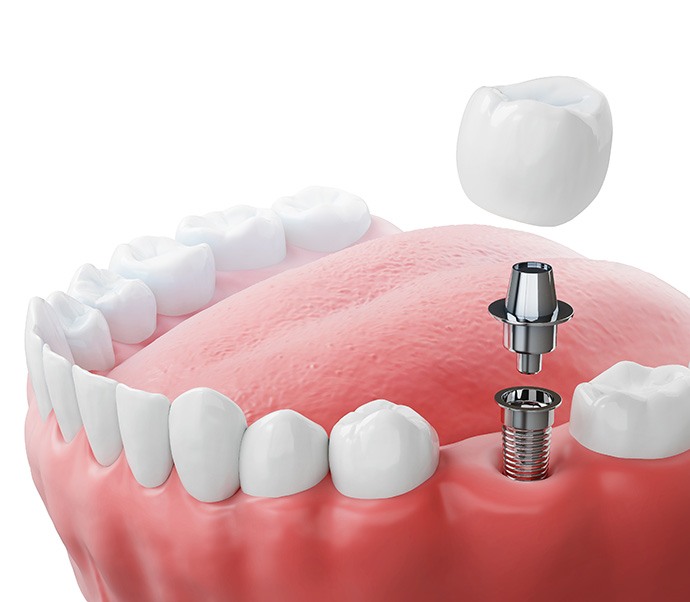 Illustration of traditional dental implant between natural teeth