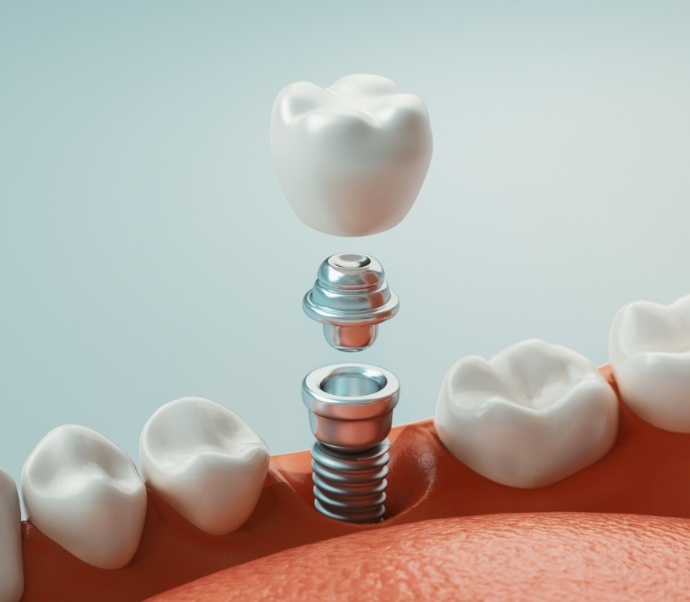 Illustrated dental implant with abutment and crown being placed in lower jaw