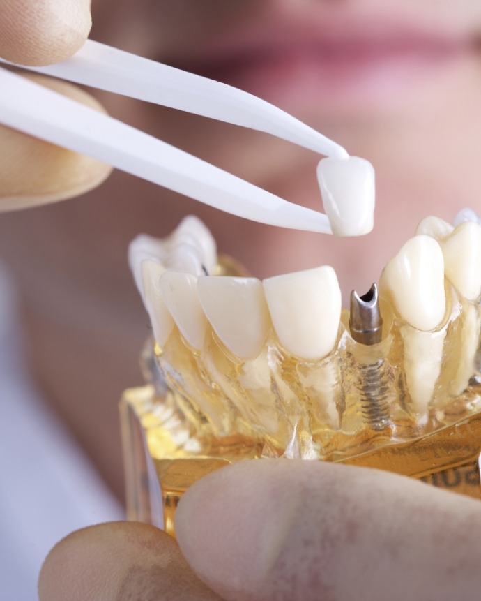 Dentist placing a crown on a dental implant in a model of the jaw