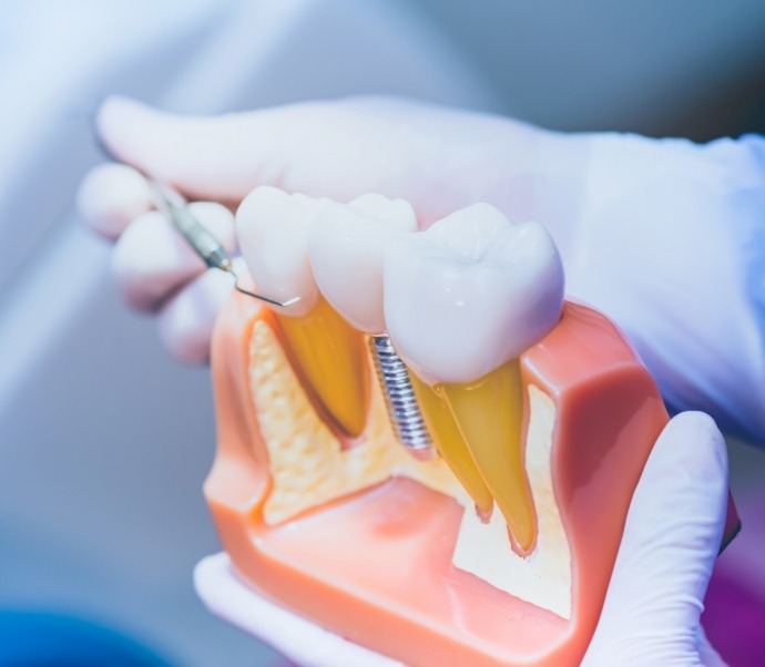 Dentist holding a dental implant model