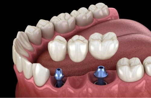 Illustrated dental bridge being placed onto two dental implants