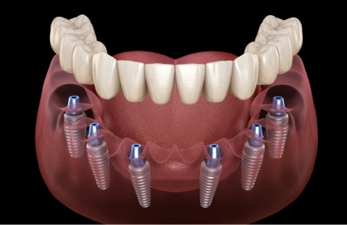 Illustrated full denture being placed onto six dental implants