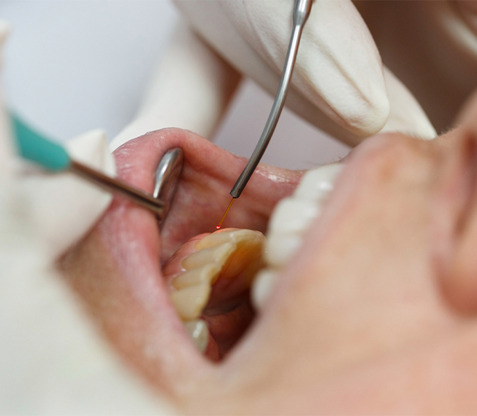 Close up of dental patient having their gums treated with dental laser