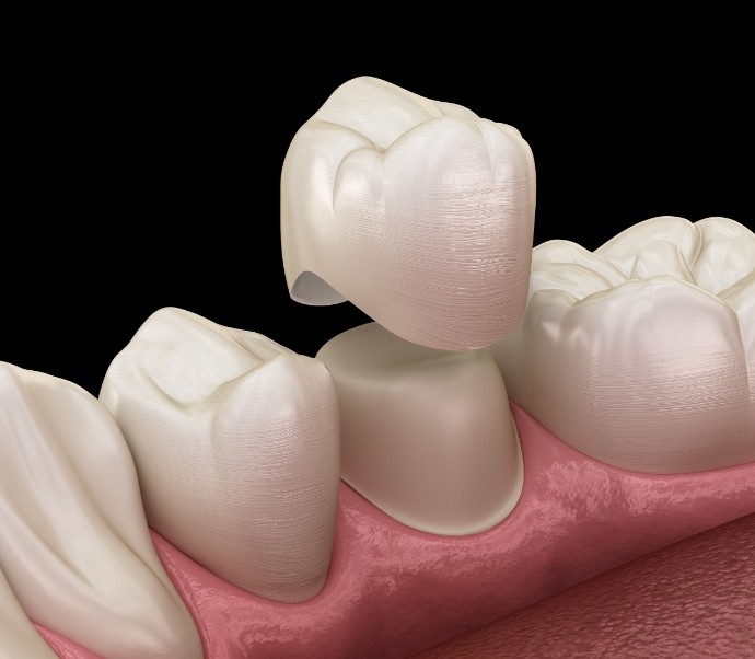 Illustrated dental crown being fitted over a tooth