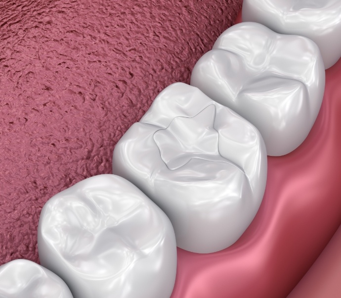 Illustrated row of teeth with white dental sealants