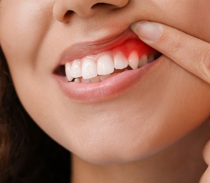 Person pointing to red spot in their gums before gum disease treatment in Braintree