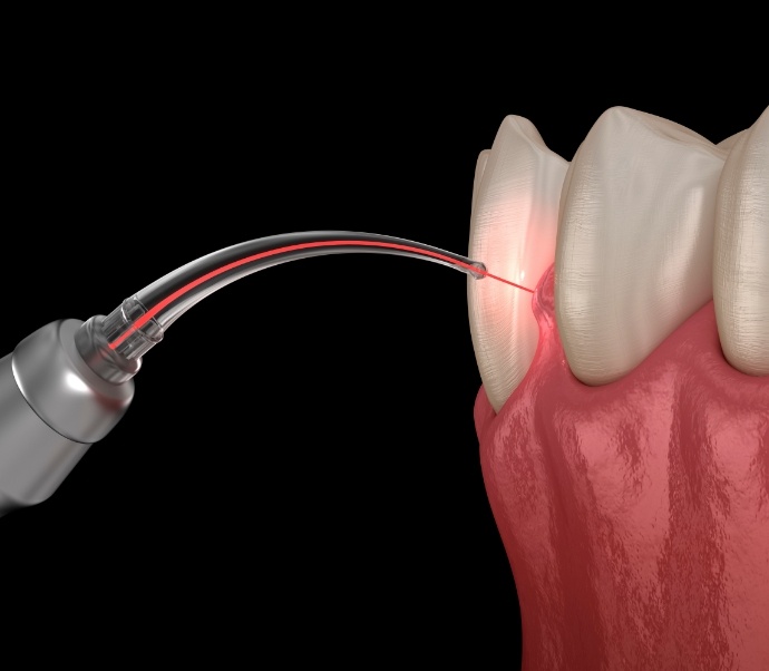 Illustrated dental laser treating gums