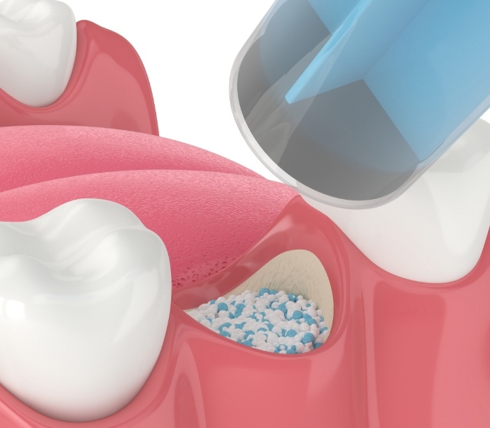 Illustrated bone grafting material being placed into jaw after tooth extraction