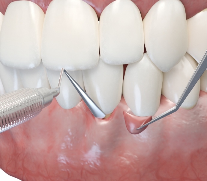 Illustration of gum grafting procedure