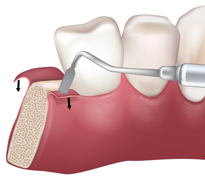 Illustrated dental instrument gently moving gum tissue