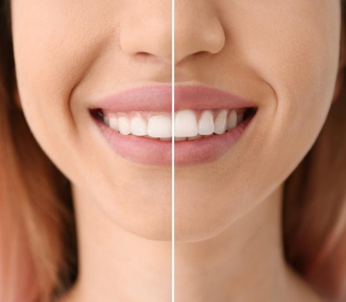 Close up of woman smiling before and after treating a gummy smile