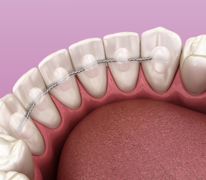 Illustrated row of teeth with braces on the backs