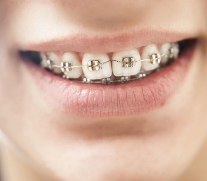 Close up of smile with traditional braces