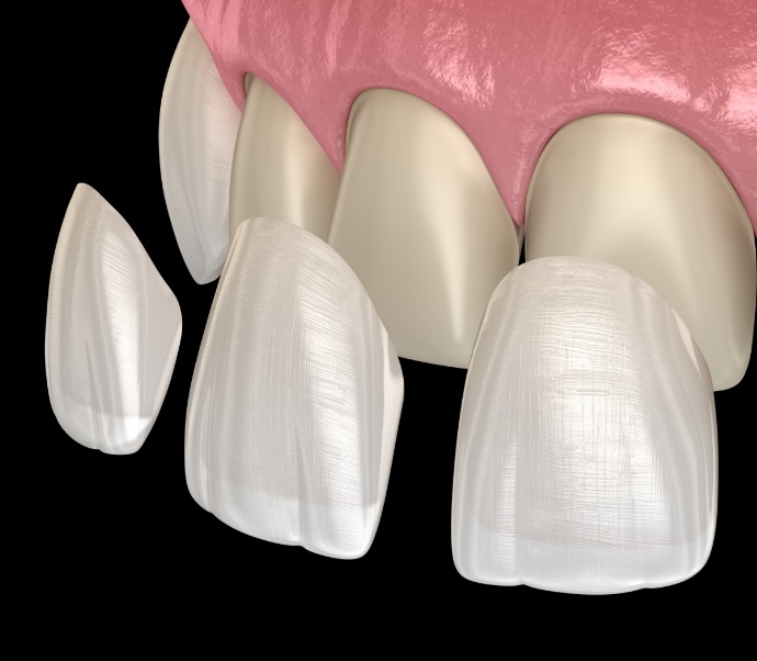 Illustrated veneers being placed over a row of upper teeth