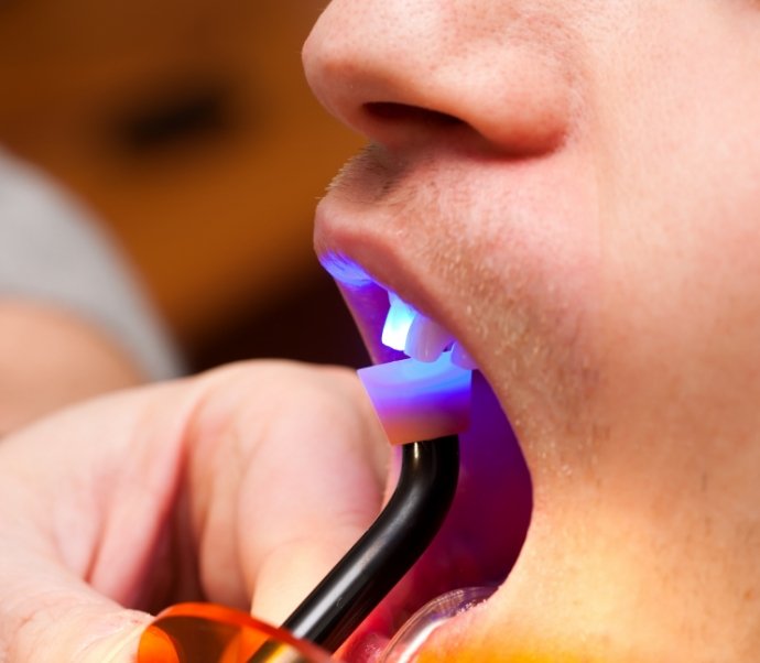 Close up of dental patient receiving bonding on upper front tooth