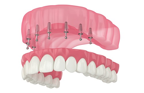 Rendering of dentures anchoring to six implants in lower jaw with pink background