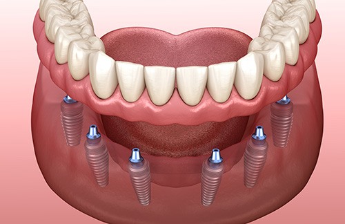 Rendering of upper arch of dentures anchored to ball-retained implants with white background