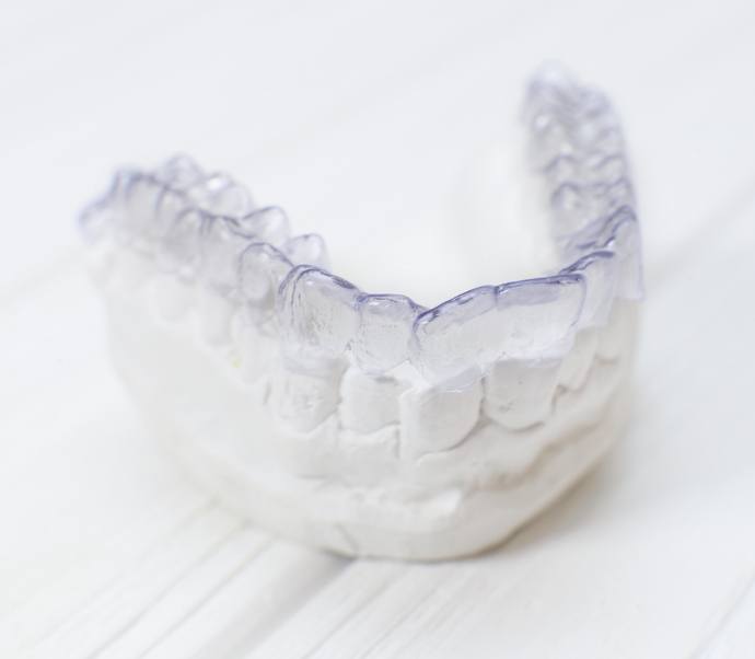 Invisalign aligner resting on model of the teeth