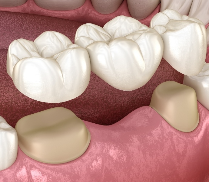 Illustrated dental bridge replacing a missing tooth