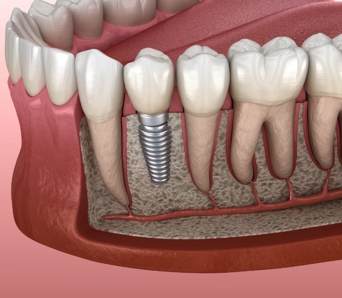 Illustrated dental implant in the lower jaw