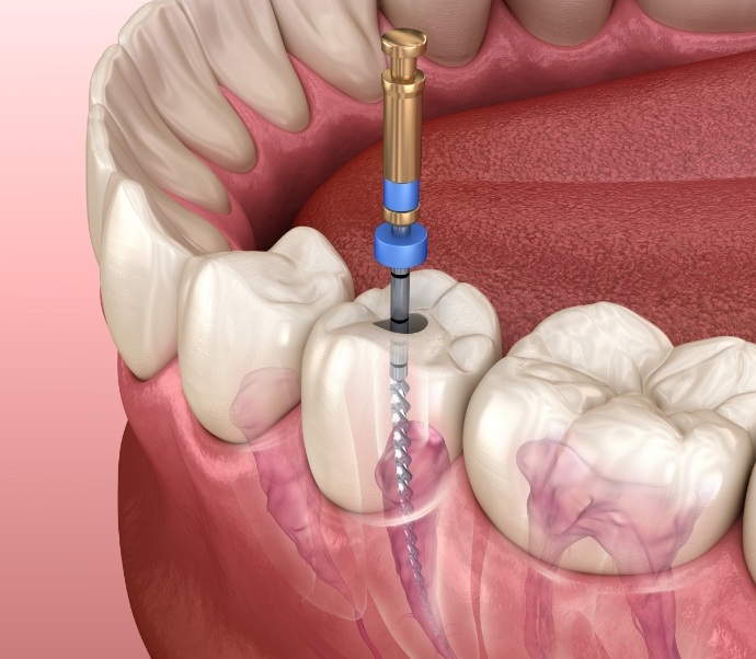 Illustrated dental instrument cleaning the inside of a tooth during root canal treatment