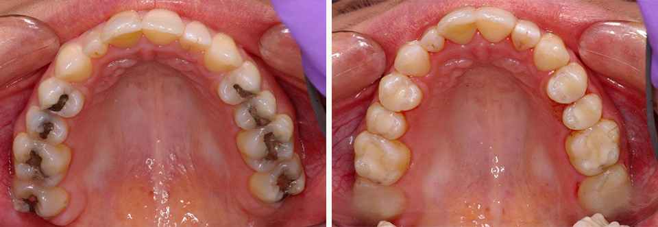 Close up of upper row of teeth before and after replacing old metal restorations