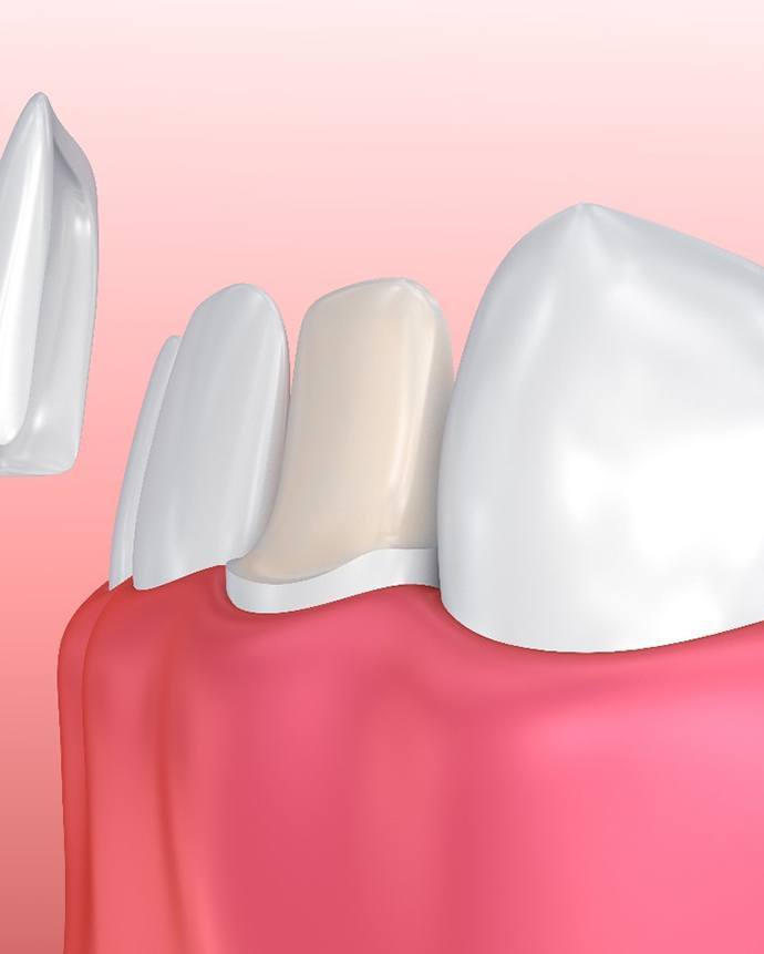 Illustration of porcelain veneer being placed on tooth