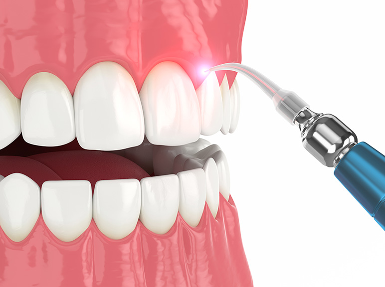 Soft Tissue Laser Dental scaler removing plaque from gums and teeth during a cleaning procedure.